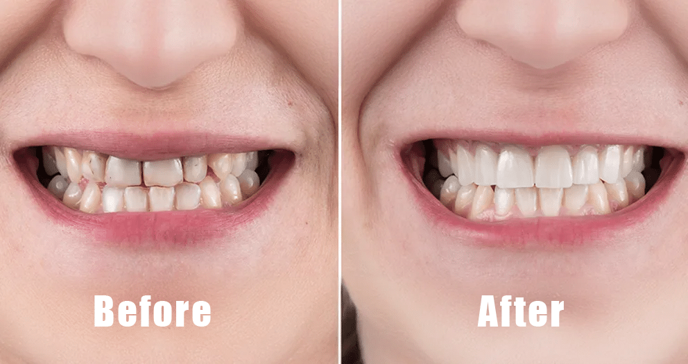 Smile Before and After ProDentim