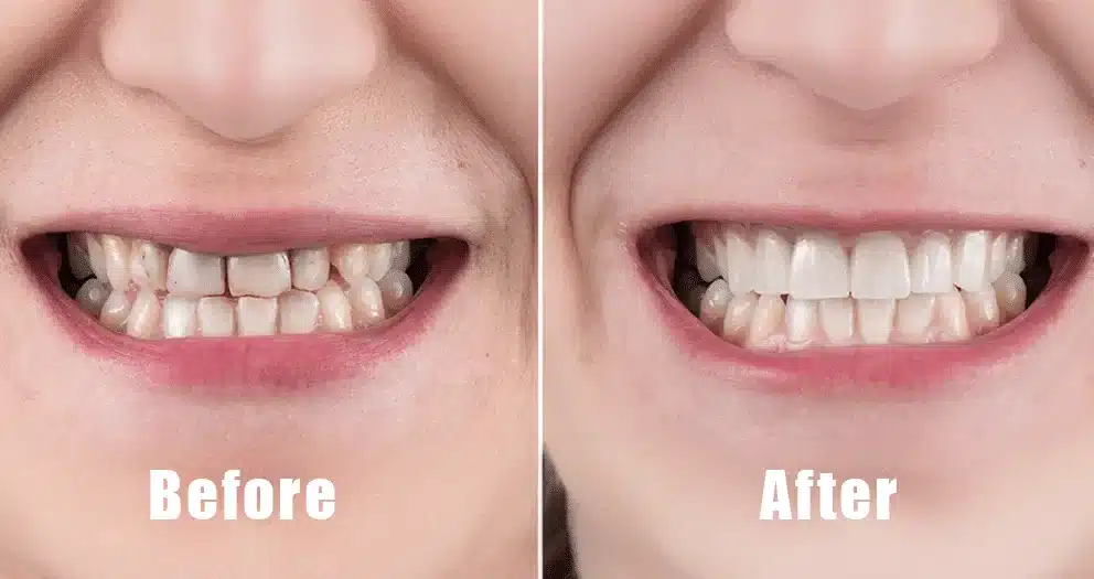 Before and after photo showing improved oral health using ProDentim